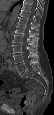 File:Baastrup CT sagittal.png
