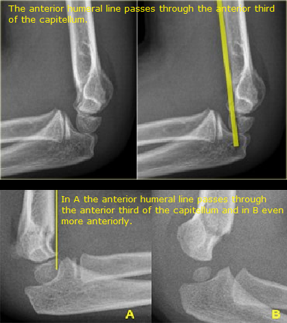 File:Anterior humeral line abnormal.png