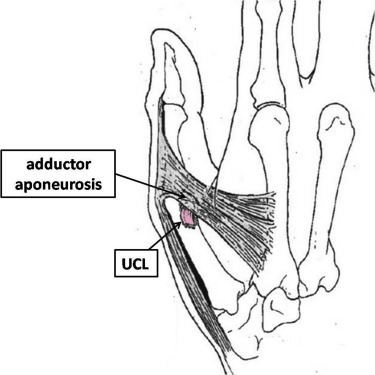 File:UCL of the thumb.jpg