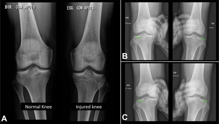 File:Radiograph of Lateral Collateral Injury.jpg