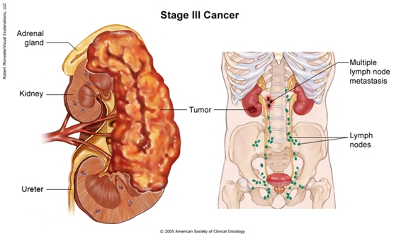 Kidneycancerstage3b.jpg