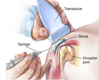 Ultrasound guided steroid injection into shoulder