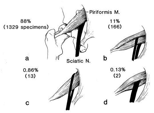 SCIATIC NERVE AND PIRIFORMIS MUSCLE VARIATION.png