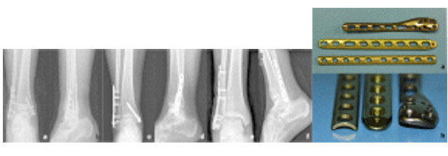 Types of plates- from left to right: conventional one-third tubular plate; a LCP metaphyseal plate; a LCP distal fibula plate