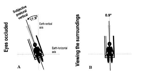 Schematic drawing of pusher patients' perceived postural vertical (SPV) with occluded eyes (A) and while viewing their surroundings (B). The patient's SPV shows a marked ipsiversive deviation from the earth-vertical with occluded eyes.