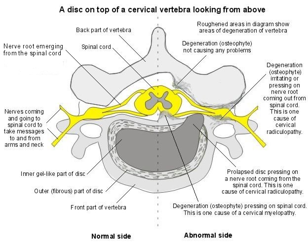 File:Cervial-radiculopathy.jpg
