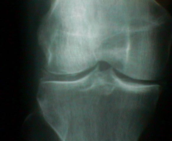 Pseudogout at the knee