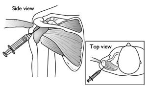 Effect of steroid injection in shoulder