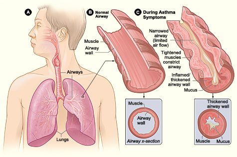 File:Asthma attack-illustration NIH.jpeg