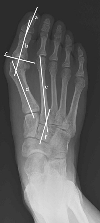 The severity of the hallux deformity is measured by (A) hallux valgus angle and (B) intermetatarsal 1-2 angle