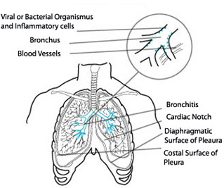 File:Acute-bronchitis.jpg