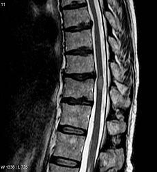 An MRI showing a Transverse myelitis lesion (the lesion is the lighter, oval shape at centre-right)