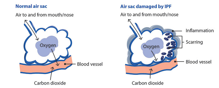 How fibrosis in IPF affects the air sacs in your lungs