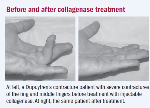 Image 6: Before and after collagenase treatment