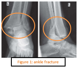 Figure 1-Ankle fracture.PNG