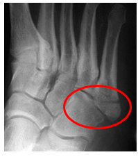 Figure 2- Foot fracture.PNG