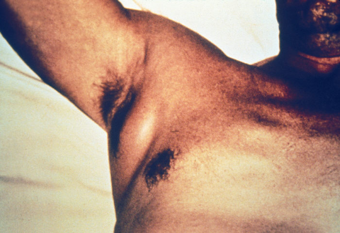 Swollen axillary lymph nodes associated with yersinia pestis. Image can be found at http://pathmicro.med.sc.edu/ghaffar/zoonoses.htm