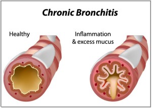 What-is-Chronic-Bronchitis-2-300x215.jpg
