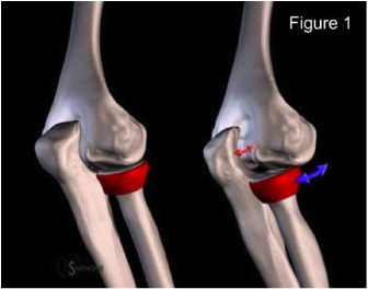 Posterolateral rotary instability is demonstrated on the right. The humeroulnar joint rotates laterally (red arrow). The annular ligament (red) remains intact, and the radius moves with the ulna and is displaced posteriorly (blue arrow) (http://www.radsource.us/clinic/0901).