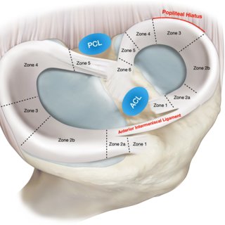 File:Medial-and-lateral-meniscus-zones-and-relevant-anatomical-relations-ACL-anterior Q320.jpeg