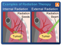 Internal-and-External-Radiation-Therapy.png