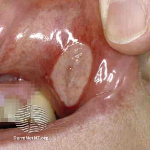 File:Oral ulcer in Behcet Syndrome.jpg