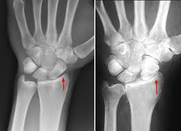 File:X-ray of Wrist arthritis.jpeg