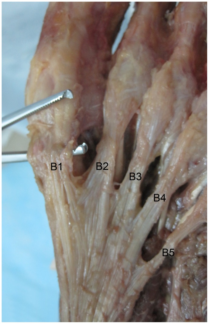 Axial view of the plantar fascia. LP, lateral part; CP, central part; MP, medial part; L, length; W, width. 118 Image above is from an open-access article: Chen D-w, Li B, Aubeeluck A, Yang Y-f, Huang Y-g, et al. (2014) Anatomy and Biomechanical Properties of the Plantar Aponeurosis: A Cadaveric Study. PLoS ONE