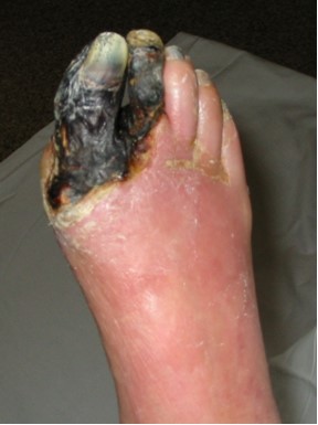 File:Diabetic foot arthropathy.jpg