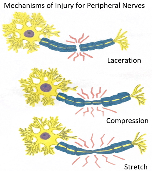 File:Mechanisms of Injury for Peripheral Nerves.png