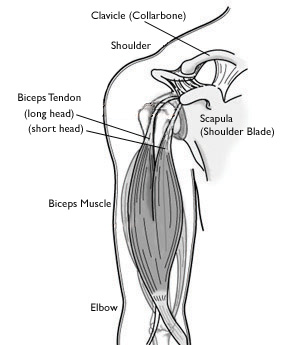 Rupture Long Head Biceps - Physiopedia