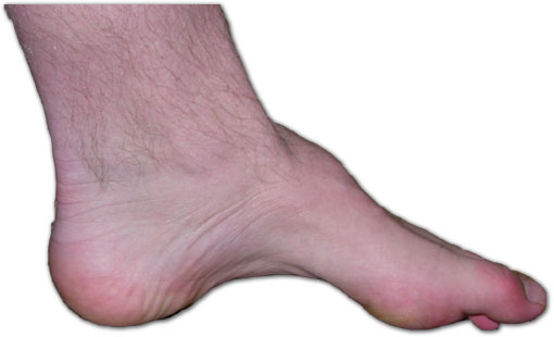 File:Charcot-marie-tooth foot.jpeg