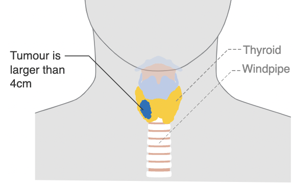 File:Thyroid cancer diagram.png