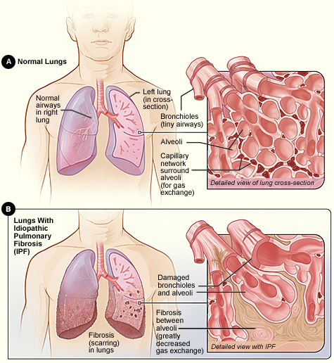Normal Lung vs Lung affected by IPF