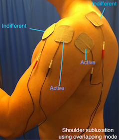 Shoulder subluxation using overlapping mode Picture.png