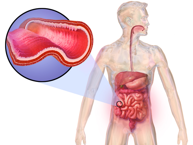 File:Crohn's Disease.png