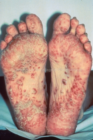 Doctor insights on: Red Rash On Big Toe Symptoms - HealthTap
