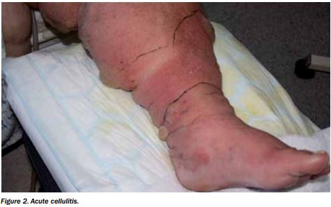 Cellulitis and lymphedema.JPG