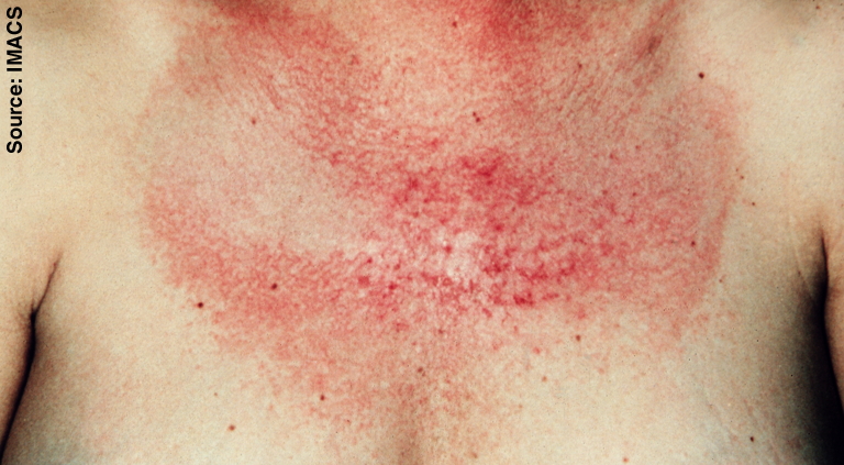 File:V-sign rash. Irregular patchy erythema.jpg