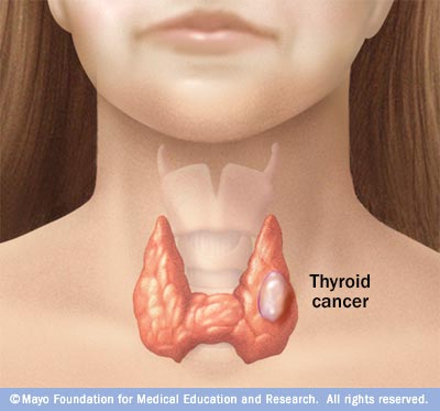 C7 thyroid cancer.jpg