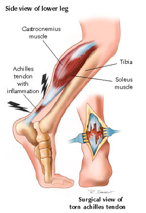 Achilles tendon rupture.jpg