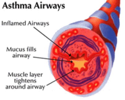 Asthma airways.png