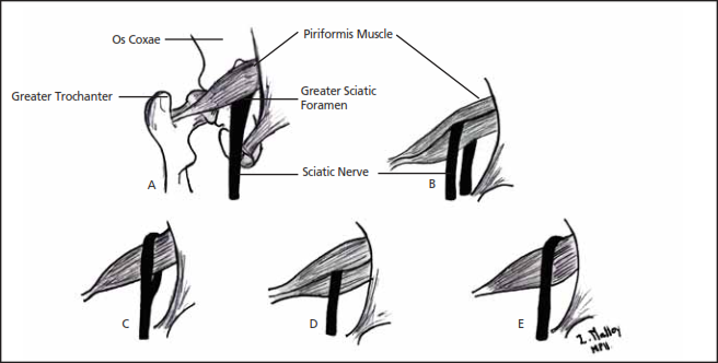 Relationship of Sciatic nerve to Piriformis