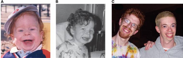 File:Williams syndrome 3 pictures resized.jpg