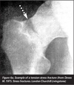 Femoral stress fracture - Physiopedia