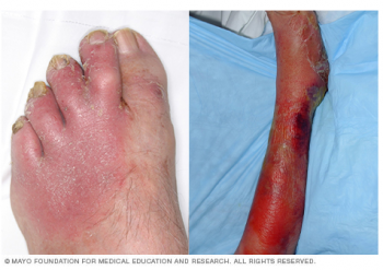 Cellulitis Mayo.PNG