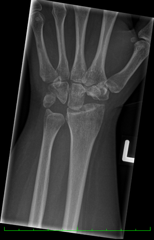 Left hand post proximal row carpectomy.png