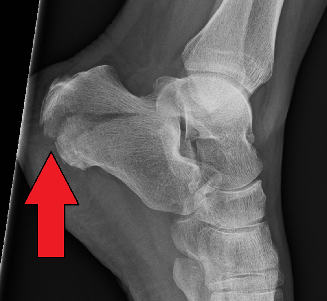 File:Radiological image of calcaneus fracture( lateral view).png