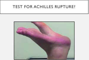 Test for Achilles Rupture.PNG