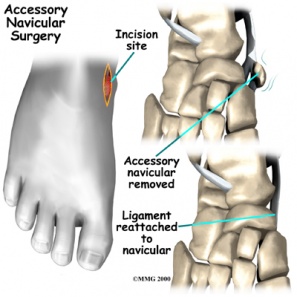 Accessory navicular surgery.jpg